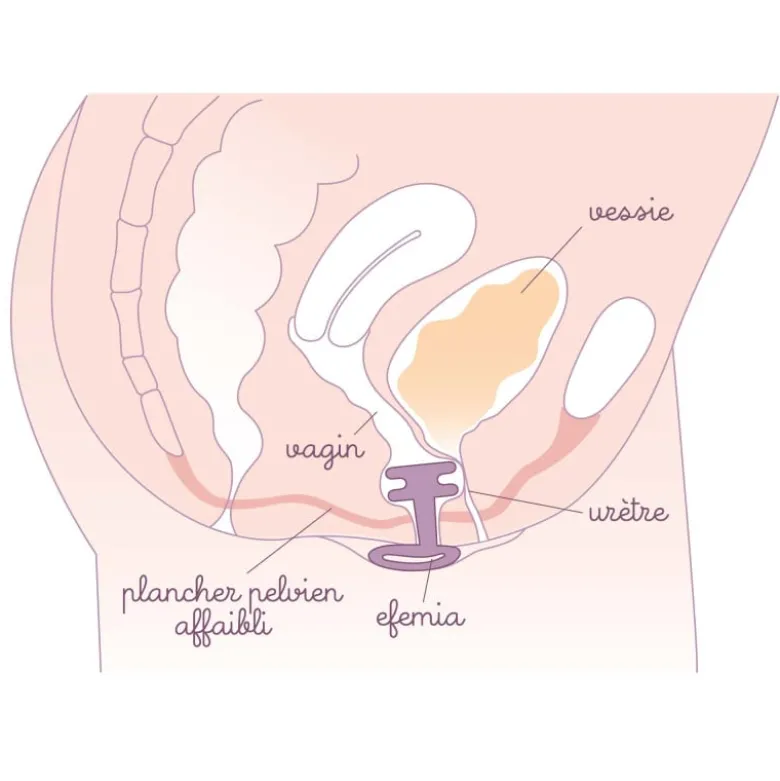 Efemia pessaire fuite urinaire